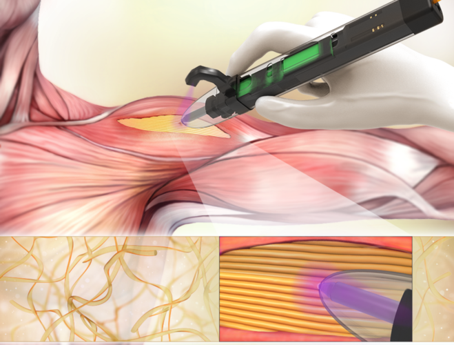 US researchers demonstrate handheld 3D bioprinter | The Engineer The ...