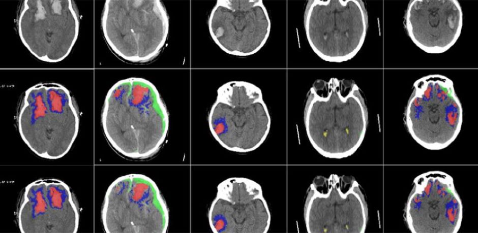 AI algorithm detects and identifies brain lesions | The Engineer The ...