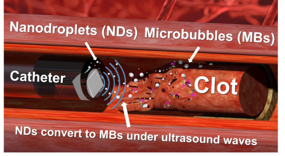 blood clots