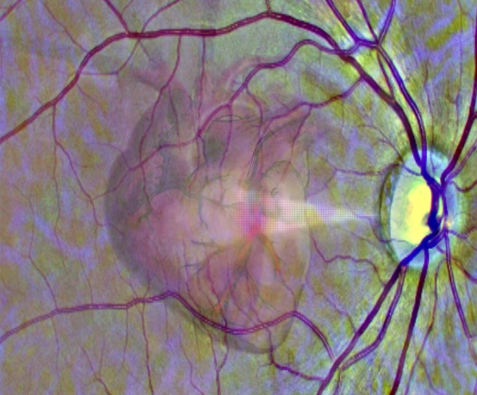 Retinal scans mined by AI to spot signs of poor heart health - Vimarsana News