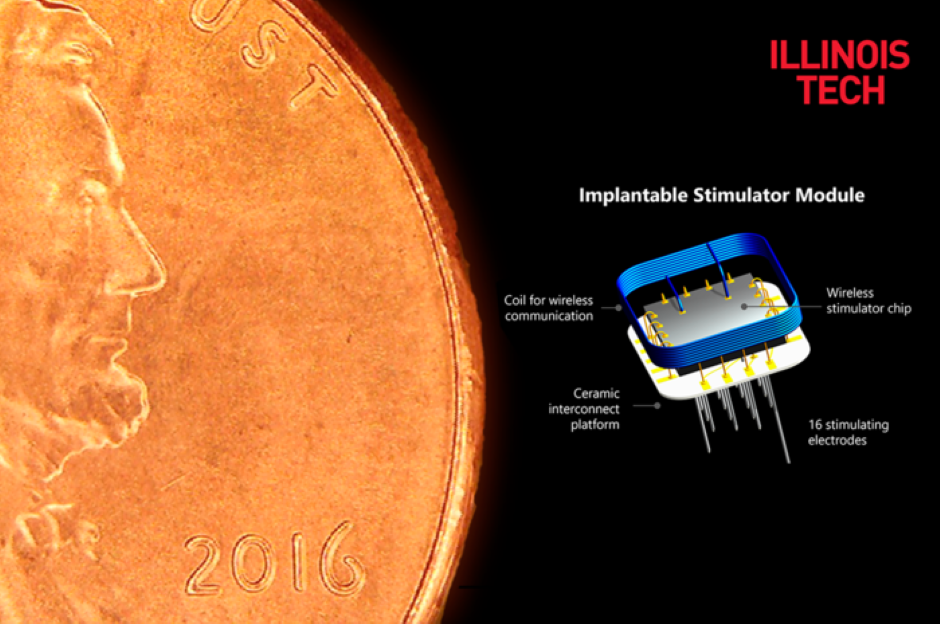 ICVP artificial vision prosthesis successfully implanted - Vimarsana News