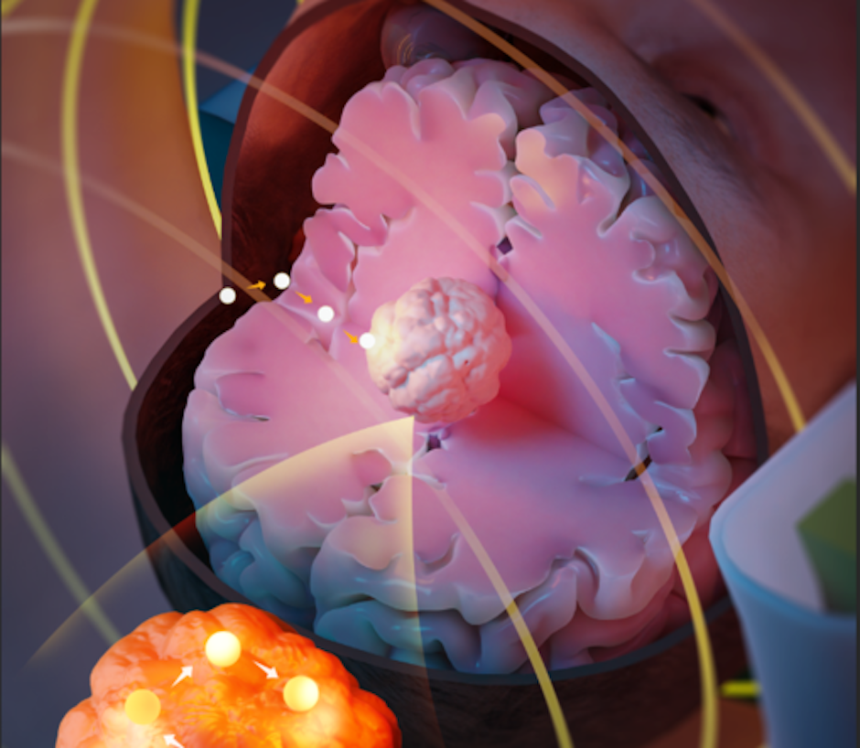 Magnetic seeds provide new cancer therapy - Vimarsana News